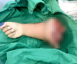 Kinh hoàng: Bé trai 8 tuổi tự chạy xe máy gặp tai nạn đứt lìa cánh tay